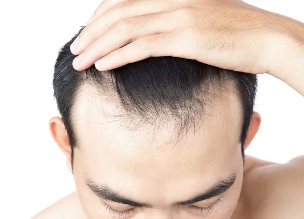 Advanced Clinics Offering Hair Replacement in Dubai