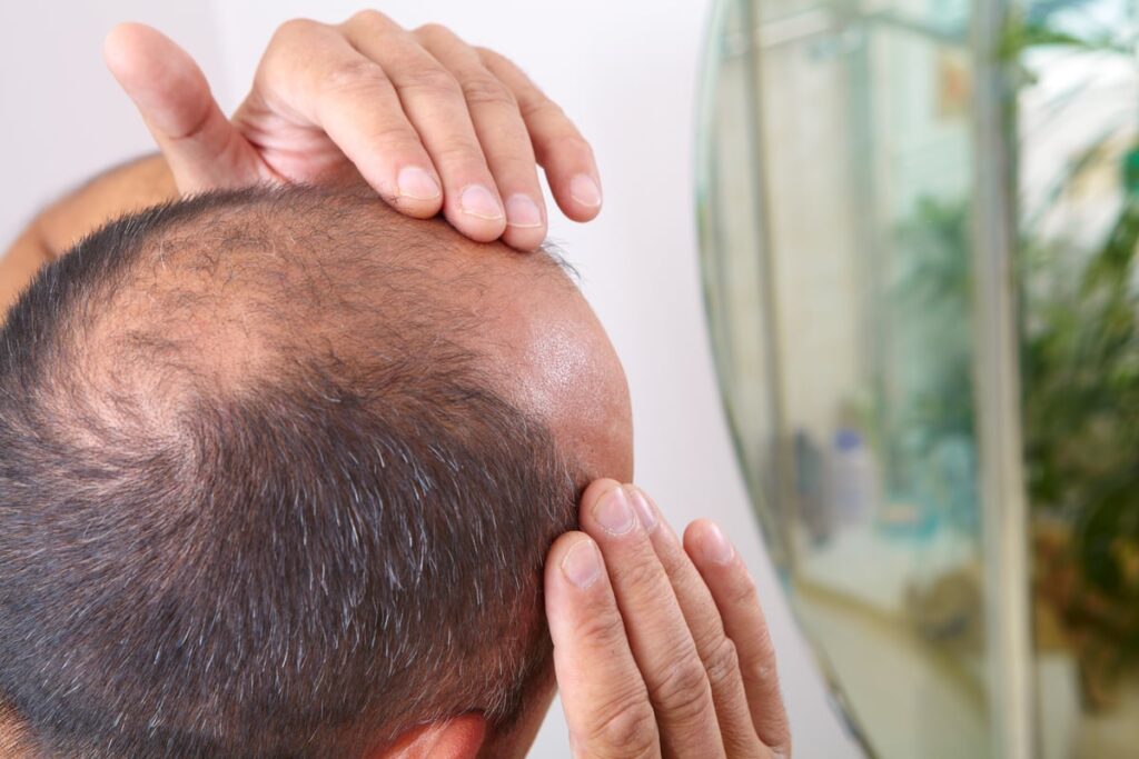 Explore Modern Male Baldness Treatment in Riyadh for Better Confidence