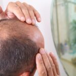 Explore Modern Male Baldness Treatment in Riyadh for Better Confidence