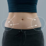 Key Factors That Influence Liposuction Recovery and Results