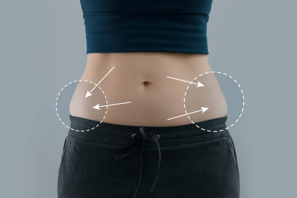 Key Factors That Influence Liposuction Recovery and Results