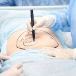 Liposuction Procedure vs Fat-Freezing: Which Option Suits Your Goals?