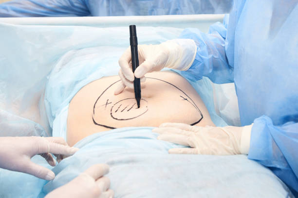 Liposuction Procedure vs Fat-Freezing: Which Option Suits Your Goals?