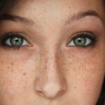 Who Should Choose Freckles and Blemishes Treatment?