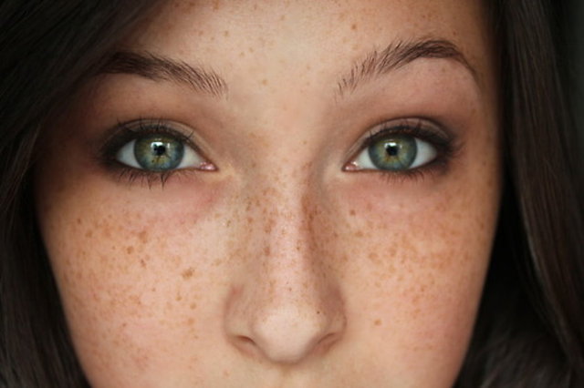 Who Should Choose Freckles and Blemishes Treatment?