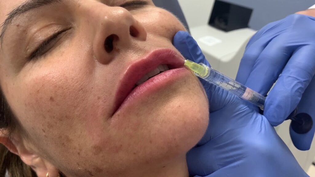 What Makes Restylane a Trusted Filler Choice Today?