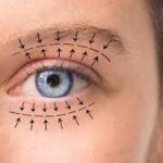 Blepharoplasty in Dubai vs. Non-Surgical Eyelid Treatments