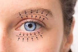 Blepharoplasty in Dubai vs. Non-Surgical Eyelid Treatments