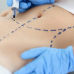Liposuction in Riyadh: A Step-by-Step Overview of the Procedure
