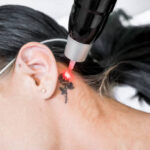 Why Following Aftercare Is Essential After Laser Tattoo Removal