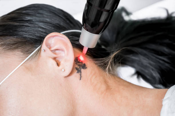 Why Following Aftercare Is Essential After Laser Tattoo Removal