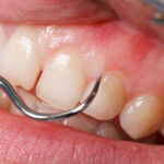 Gum Disease: What It Is, Causes, Symptoms, and Treatment Options