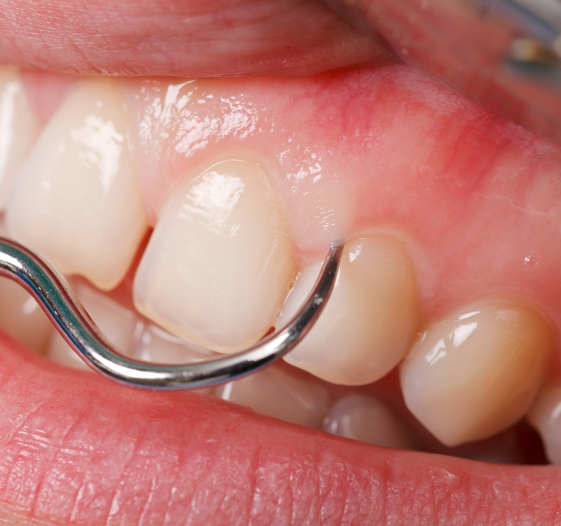Gum Disease: What It Is, Causes, Symptoms, and Treatment Options