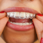 Can Clear Aligners Fix Complex Dental Alignment Issues?