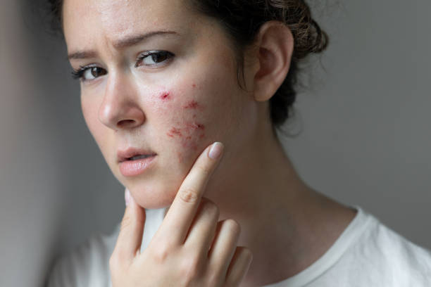 Does Laser Acne Scar Treatment Hurt? What to Expect