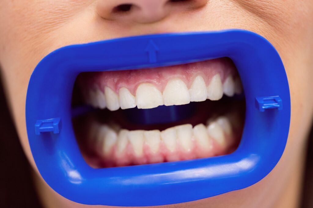 Why a Custom Mouth Guard Is Worth the Investment for Long-Term Oral Health