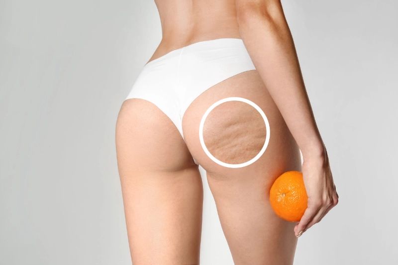 Non Surgical Butt Lift in Dubai: Firm and Lifted