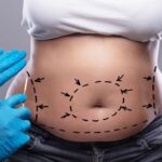 Tummy Tuck in Dubai: Restoring Your Pre-Baby Body