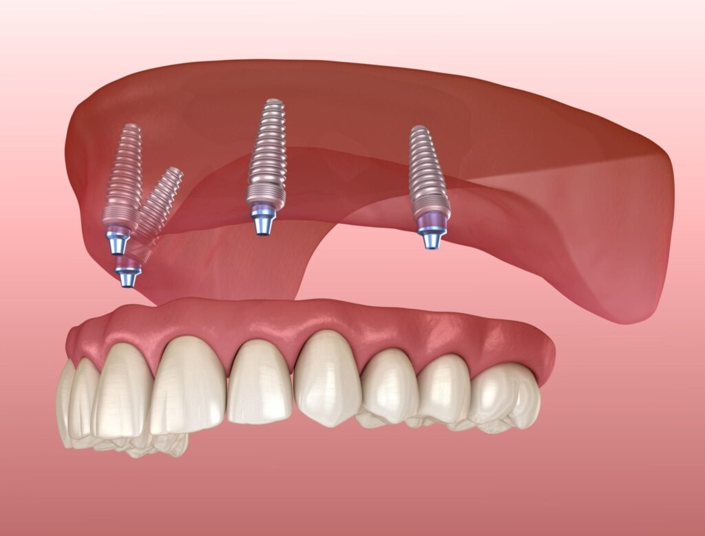 Common Denture Problems and Simple Solutions: A Complete Guide for Denture Wearers