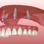 Common Denture Problems and Simple Solutions: A Complete Guide for Denture Wearers