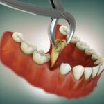 What Happens If You Delay a Necessary Tooth Extraction?