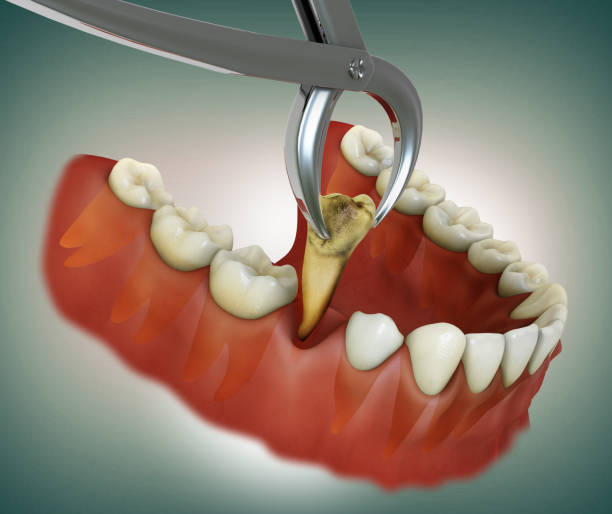 What Happens If You Delay a Necessary Tooth Extraction?