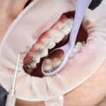 How Much Are Braces in California? A Complete Cost Guide