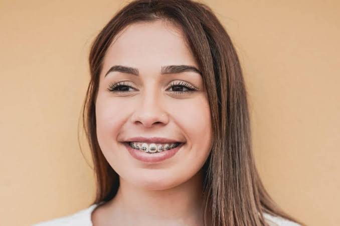 Can Adults Get Braces? Everything You Need to Know