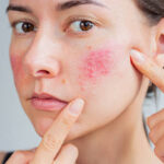 Acne Treatment While On Contraception: What to Know