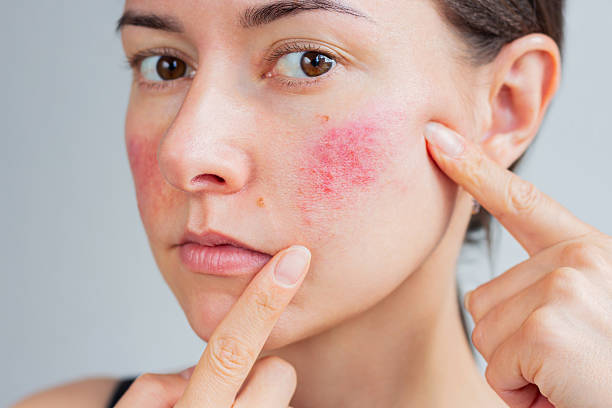 Acne Treatment While On Contraception: What to Know