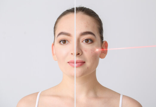 Understanding the Effects of Back Acne on Skin Appearance