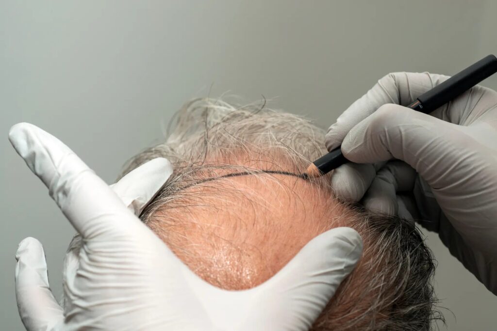 Medical Centers Providing DHI Direct Hair Implant in Dubai