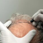 Medical Centers Providing DHI Direct Hair Implant in Dubai
