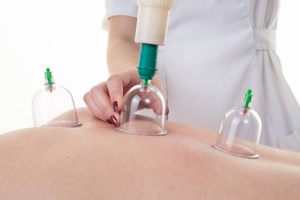 Embrace Healing: How Cupping Therapy Transformed Anjali's Life