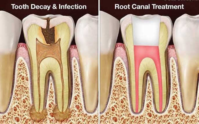 Transforming Smiles: How RCT Saved Meeta’s Dental Health