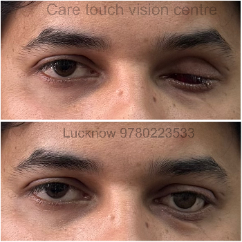 Embracing Confidence: How Artificial Eyes are Transforming Lives in India | CARE TOUCH VISION CENTRE