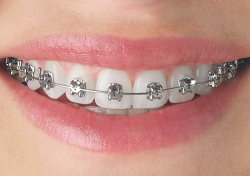 Understanding Orthodontic Treatment