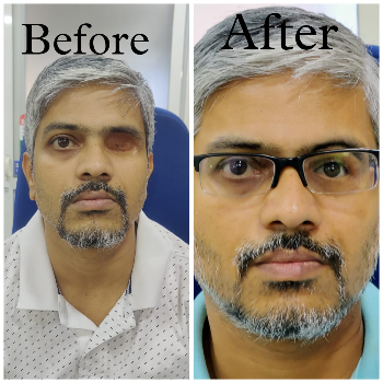 Silicon Orbital Facial Prosthetics CARE TOUCH VISION CENTRE 439B 202  MALIHABAD ROAD  THAKUR GANJ