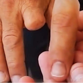 Silicon Finger Prosthesis CARE TOUCH VISION CENTRE 439B 202  MALIHABAD ROAD  THAKUR GANJ