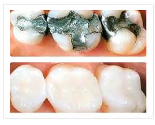 Dental Restoration Treatment MODERN ORAL AND DENTAL CLINIC Tenduni, Bikramganj, Rohtas
