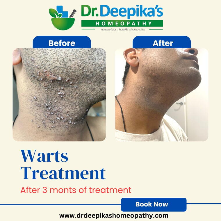 WartsVanish Pro : Visible results in warts within 60 days of treatment