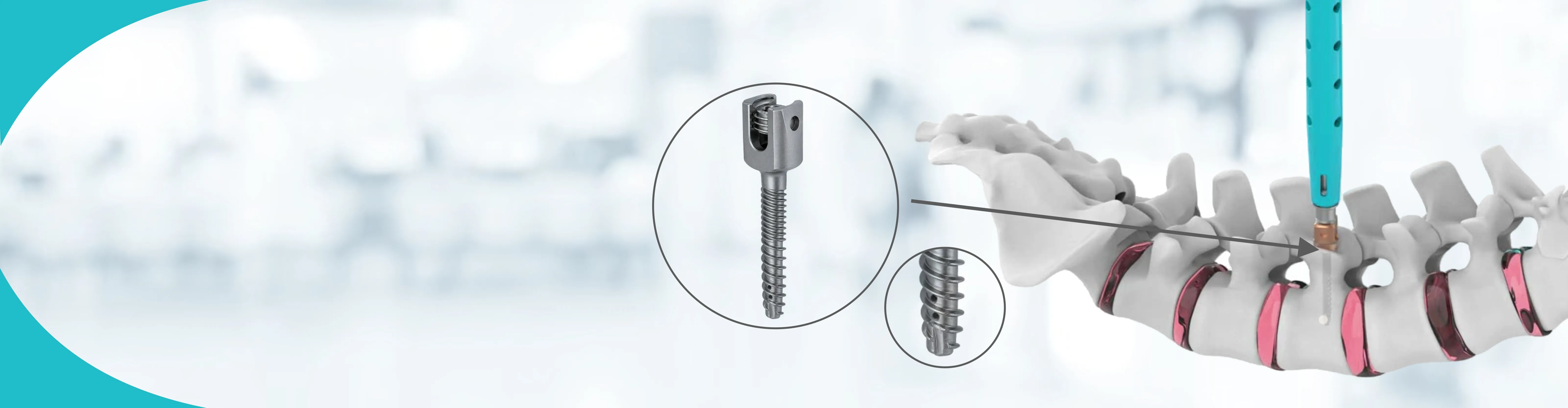Monoaxial Pedicle Screws