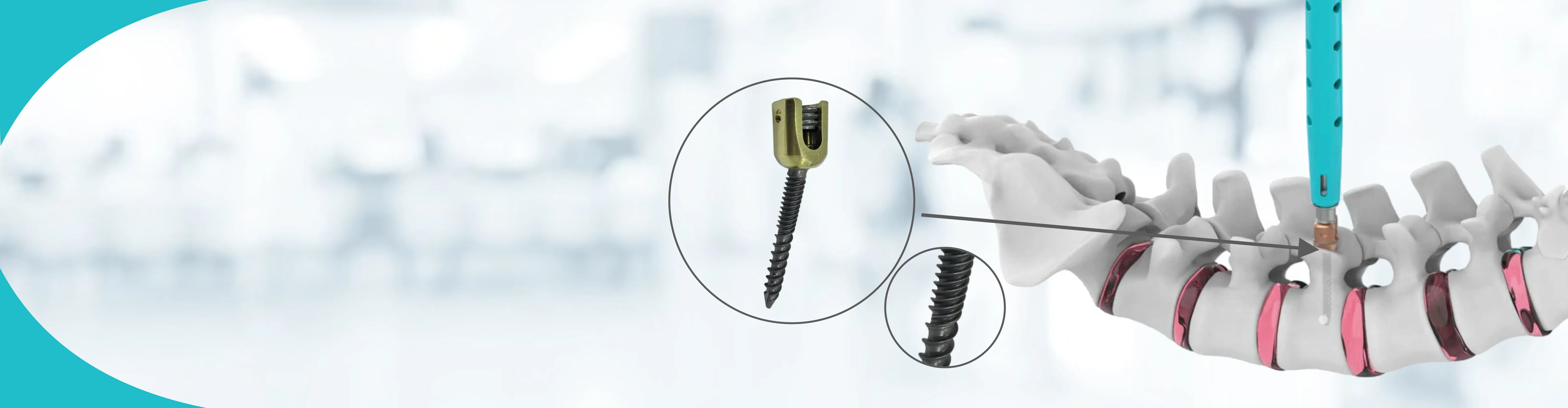 Polyaxial Pedicle Screws