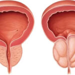 Prostate Hospital in Coimbatore – Advanced Care and Effective Prostate Treatment