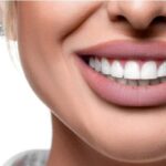 Hollywood Smile Makeover in Dubai – Star-Worthy Smiles