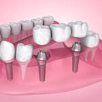The Truth About Low-Cost Dental Implants in Glendale, AZ