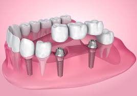 The Truth About Low-Cost Dental Implants in Glendale, AZ