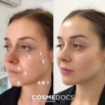 Blepharoplasty Surgery: Revive, Refresh, and Brighten Your Eyes
