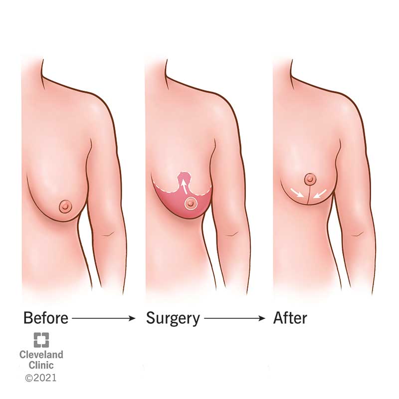 Boob Job Surgery: Enhance Shape, Volume, and Confidence