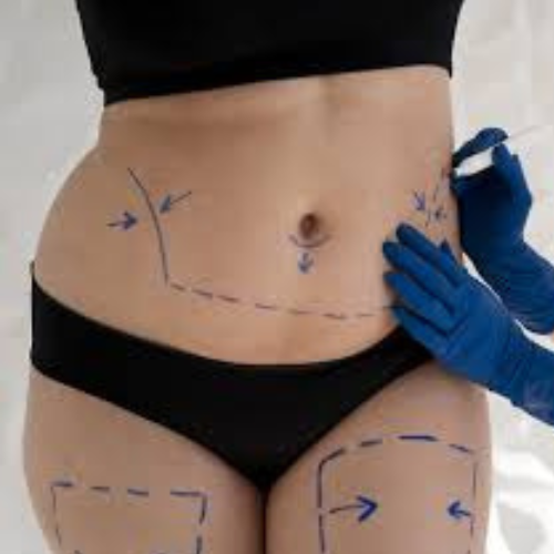 Professional Liposuction Surgery in Istanbul – Simple Guide for Fat Removal